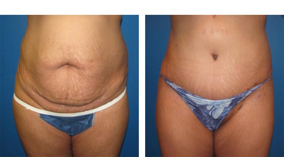 Before and After Photos |Tummy Tuck| 33 year old female, - front view