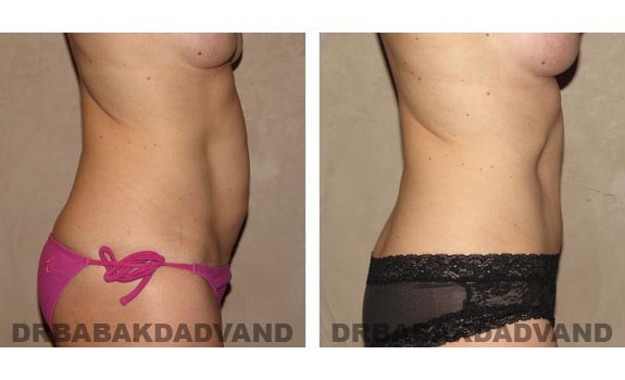 Before and After Photos |Tummy Tuck| 42 year old female, - right side view