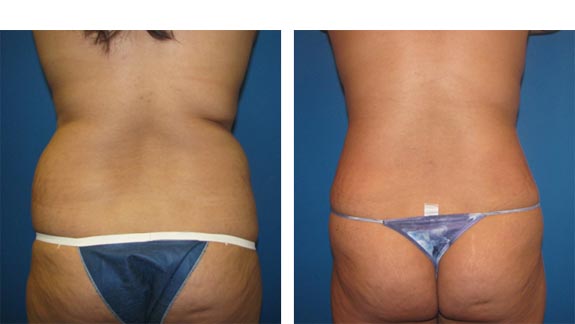 Before and After Photos |Tummy Tuck| 33 year old female, - back view