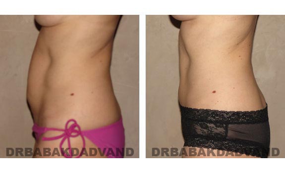 Before and After Photos |Tummy Tuck| 42 year old female, - left side view