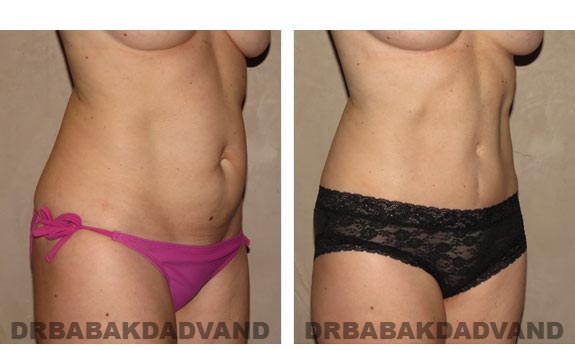 Before and After Photos |Tummy Tuck| 42 year old female, - right side, oblique view