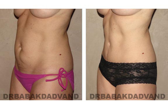 Before and After Photos |Tummy Tuck| 42 year old female, - left side, oblique view