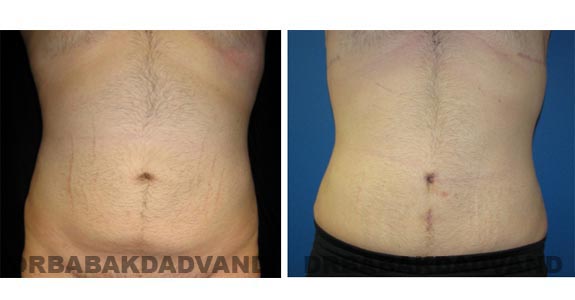 Before and After Photos |Tummy Tuck| 26 year old male, - front view