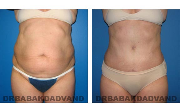 Before and After Photos |Tummy Tuck| 51 year old female, - front view
