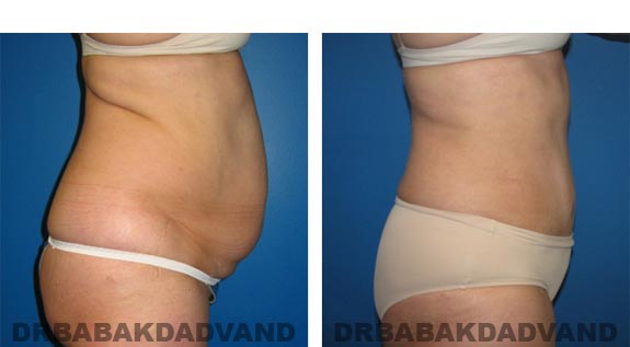 Before and After Photos |Tummy Tuck| 51 year old female, - right side view