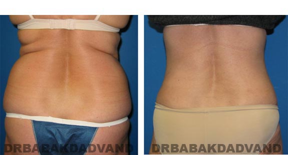 Before and After Photos |Tummy Tuck| 51 year old female, - back view