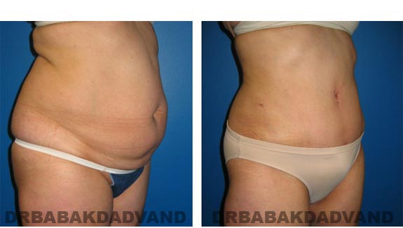 Before and After Photos |Tummy Tuck| 51 year old female, - right side, oblique view