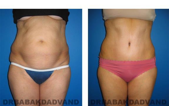 Before and After Photos |Tummy Tuck| 59 year old female, - front view