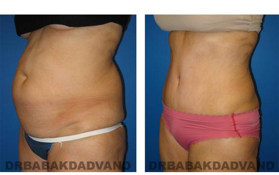 Before and After Photos |Tummy Tuck| 59 year old female, - left side, oblique view