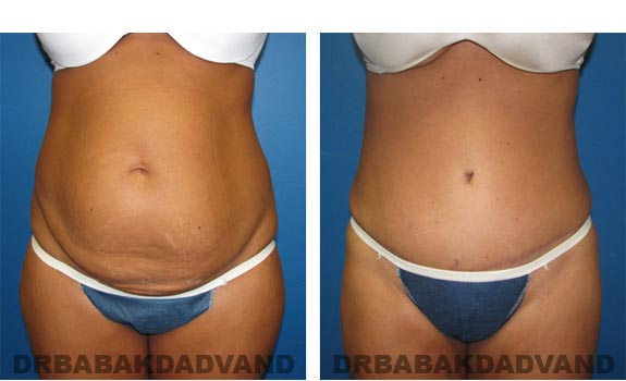Before and After Photos |Tummy Tuck| 41 year old female, - front view