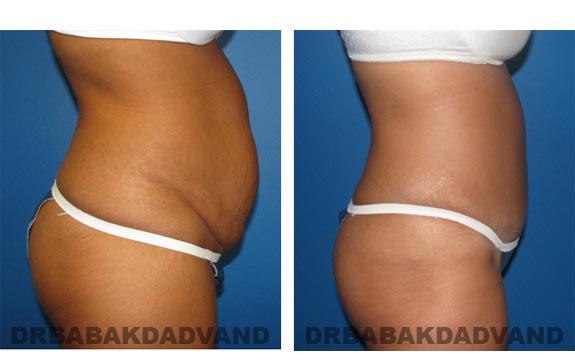 Before and After Photos |Tummy Tuck| 41 year old female, - right side view