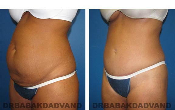 Before and After Photos |Tummy Tuck| 41 year old female, - left side, oblique view