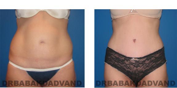Before and After Photos |Tummy Tuck| 35 year old woman, - front view
