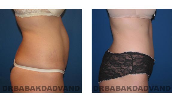 Before and After Photos |Tummy Tuck| 35 year old woman, - right side view