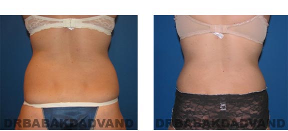 Before and After Photos |Tummy Tuck| 35 year old woman, - back view