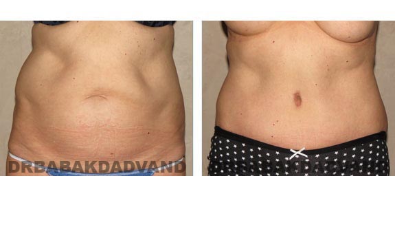 Before and After Photos |Tummy Tuck| 58 year old female, - front view