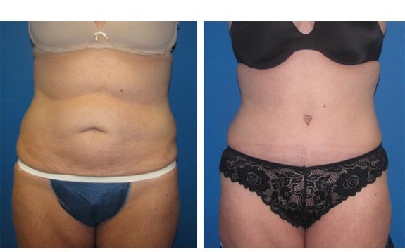 Before and After Photos |Tummy Tuck| 46 year old woman, - front view