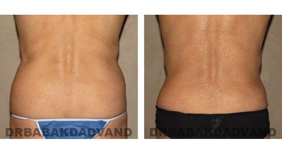 Before and After Photos |Tummy Tuck| 58 year old female, - back view
