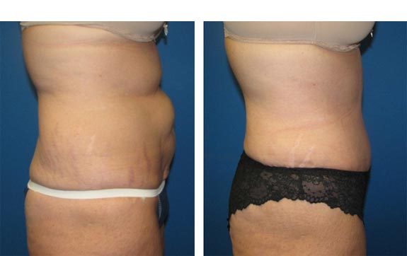 Before and After Photos |Tummy Tuck| 46 year old woman, - right side view