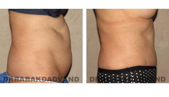 Before and After Photos |Tummy Tuck| 58 year old female, - right side view