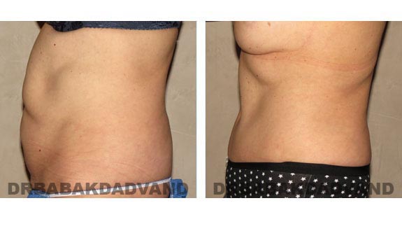Before and After Photos |Tummy Tuck| 58 year old female, - left side view