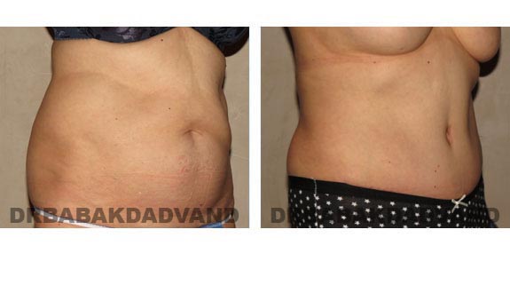 Before and After Photos |Tummy Tuck| 58 year old female, - right side, oblique view