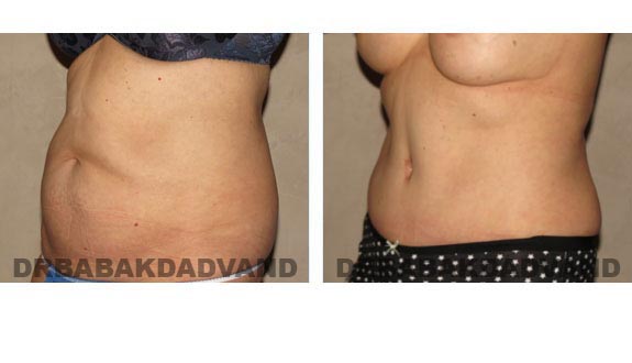 Before and After Photos |Tummy Tuck| 58 year old female, - left side, oblique view