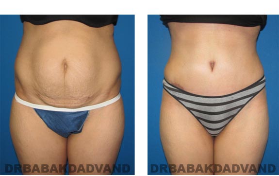 Before and After Photos |Tummy Tuck| 44 year old woman, - front view