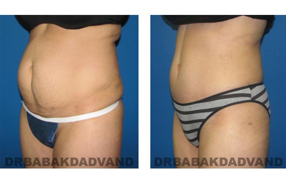 Before and After Photos |Tummy Tuck| 44 year old woman, - left side, oblique view