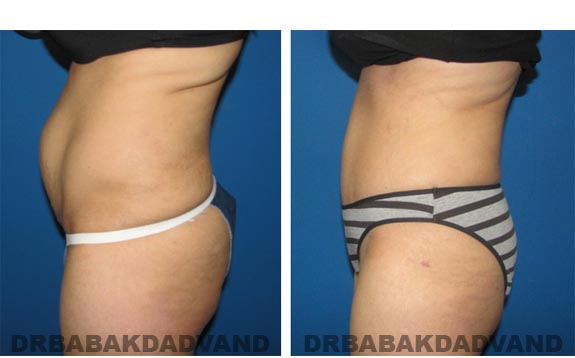 Before and After Photos |Tummy Tuck| 44 year old woman, - left side view