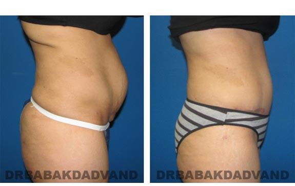 Before and After Photos |Tummy Tuck| 44 year old woman, - right side view