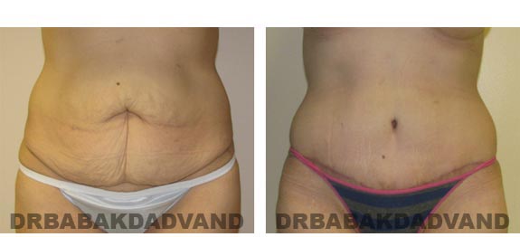 Before and After Photos |Tummy Tuck| 37 year old woman, - front view