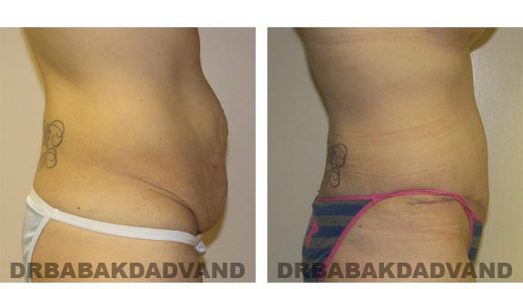 Before and After Photos |Tummy Tuck| 37 year old woman, - right side view