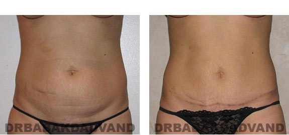 Before and After Photos |Tummy Tuck| 28 year old woman, - front view
