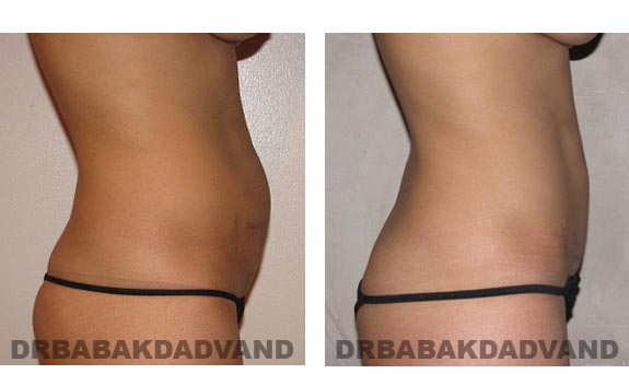 Before and After Photos |Tummy Tuck| 28 year old woman, - right side view