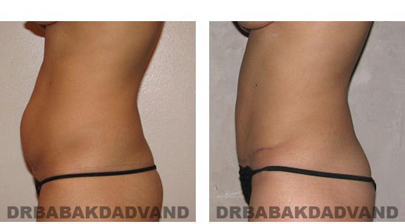 Before and After Photos |Tummy Tuck| 28 year old woman, - left side view