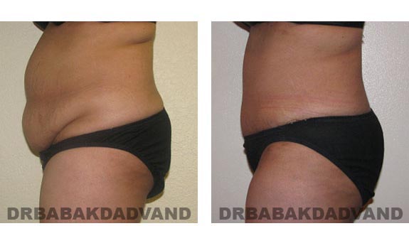 Before and After Photos |Tummy Tuck| 33 year old woman, - left side view