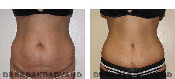 Before & After Photos |Tummy Tuck| 44 year old woman, - front view