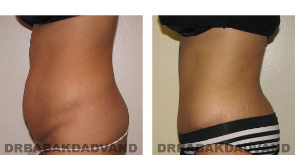 Before & After Photos |Tummy Tuck| 44 year old woman, - left side view
