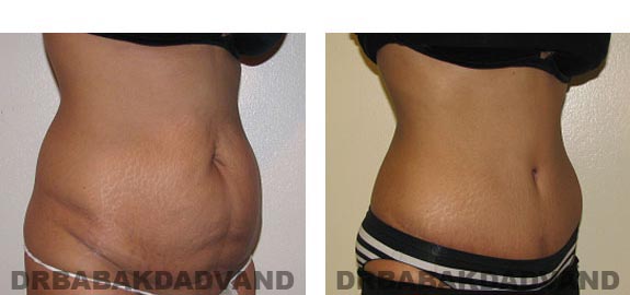 Before & After Photos |Tummy Tuck| 44 year old woman, - right side, oblique view