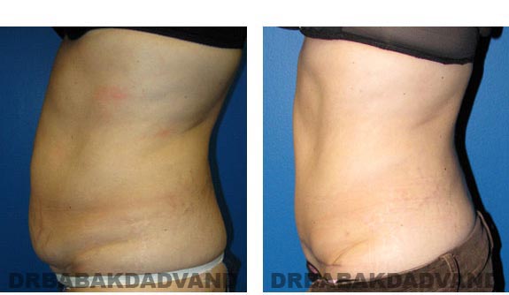 Before & After Photos |Tummy Tuck| 42 year old woman, - left side view