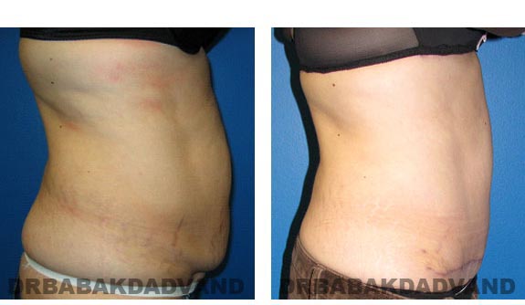 Before & After Photos |Tummy Tuck| 42 year old woman, - right side view