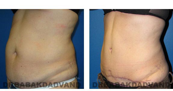 Before & After Photos |Tummy Tuck| 42 year old woman, - left side, oblique view
