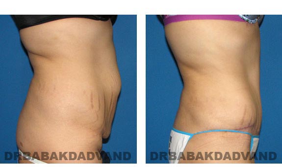 Before & After Photos |Tummy Tuck| 26 year old woman, - right side view