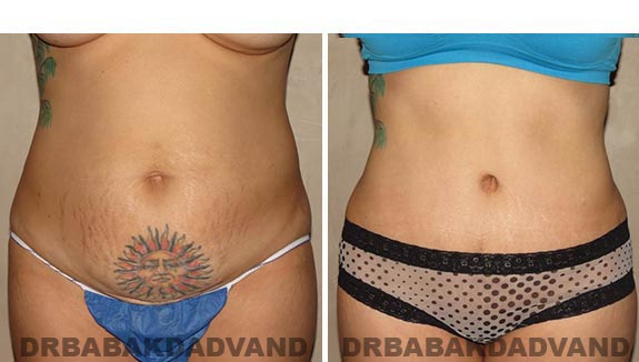 Before and After Photos |Tummy Tuck| 35 year old female, - front view