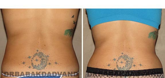 Before and After Photos |Tummy Tuck| 35 year old female, - back view