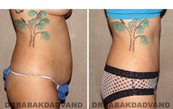 Before and After Photos |Tummy Tuck| 35 year old female, - right side view