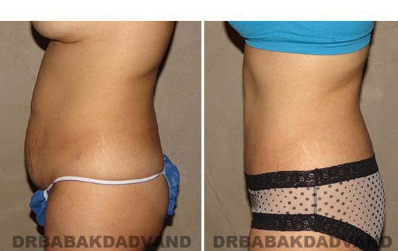 Before and After Photos |Tummy Tuck| 35 year old female, - left side view