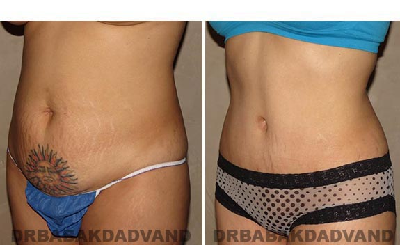 Before and After Photos |Tummy Tuck| 35 year old female, - left side, oblique view