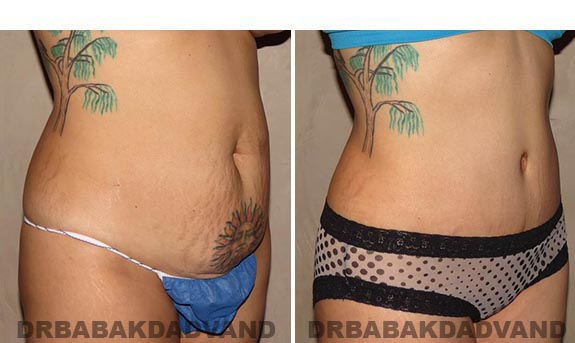 Before and After Photos |Tummy Tuck| 35 year old female, - right side, oblique view